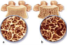 Nhuyễn xương - Hình ảnh minh họa